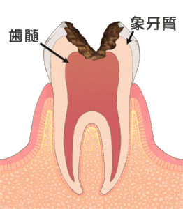 歯髄（歯の神経）の痛み　歯の痛み