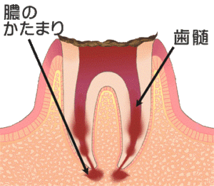 歯の根っこの痛み　歯の痛み