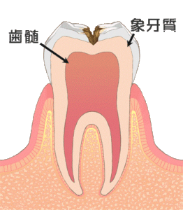 象牙質の痛み　歯の痛み