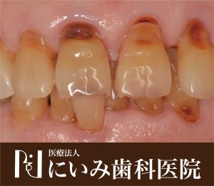 三重県四日市_にいみ歯科医院_口臭5